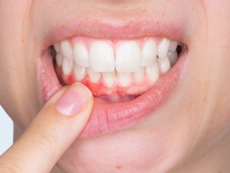 Tổng quan về bệnh viêm nướu