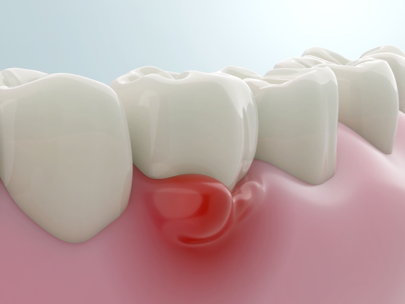 Bàn chải điện bị mốc làm tăng nguy cơ nhiễm khuẩn trong khoang miệng