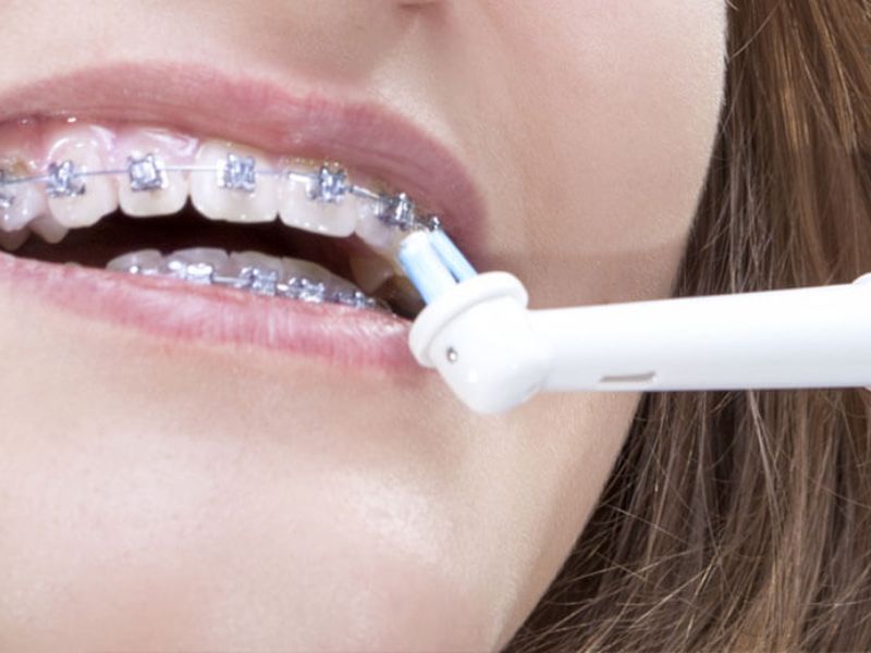  Ưu tiên đầu bàn chải có lông mềm khi chọn bàn chải điện cho người niềng