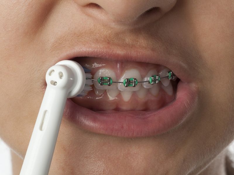 Nhiều người đặt câu hỏi “Niềng răng có nên dùng bàn chải điện không?”