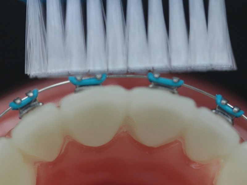 Một thiết kế thông minh khác bạn nên cân nhắc là đầu bàn chải có rãnh giữa làm sạch mắc cài