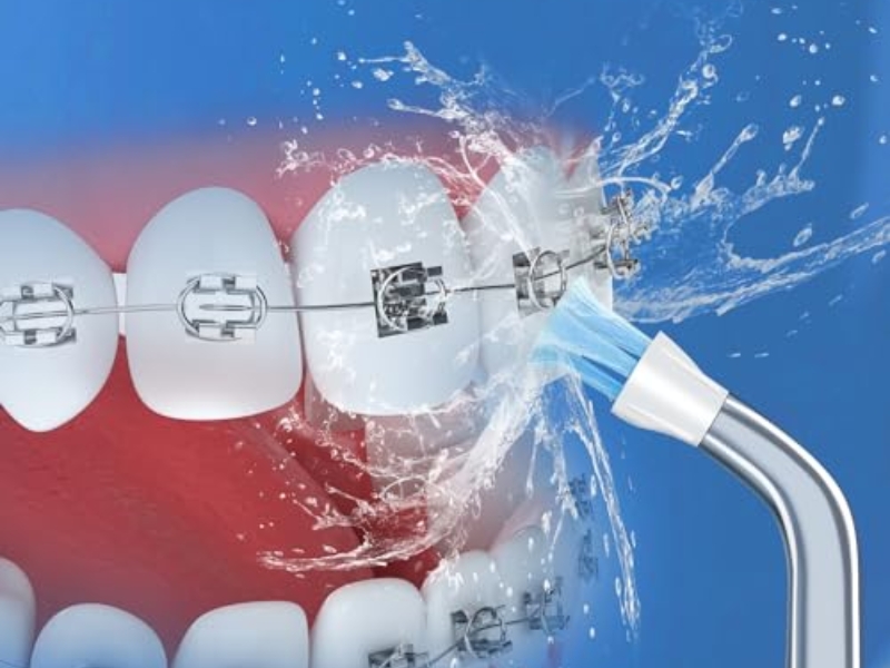 Người niềng răng nên chọn máy có đầu tăm chuyên dụng cho chỉnh nha