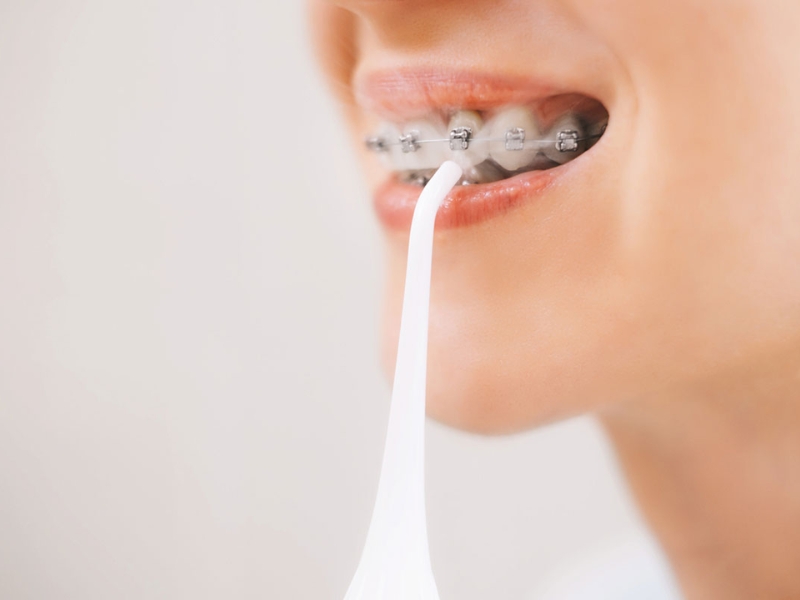 Máy tăm nước cho người niềng răng làm sạch thức ăn thừa và mảng bám trên răng và bộ niềng