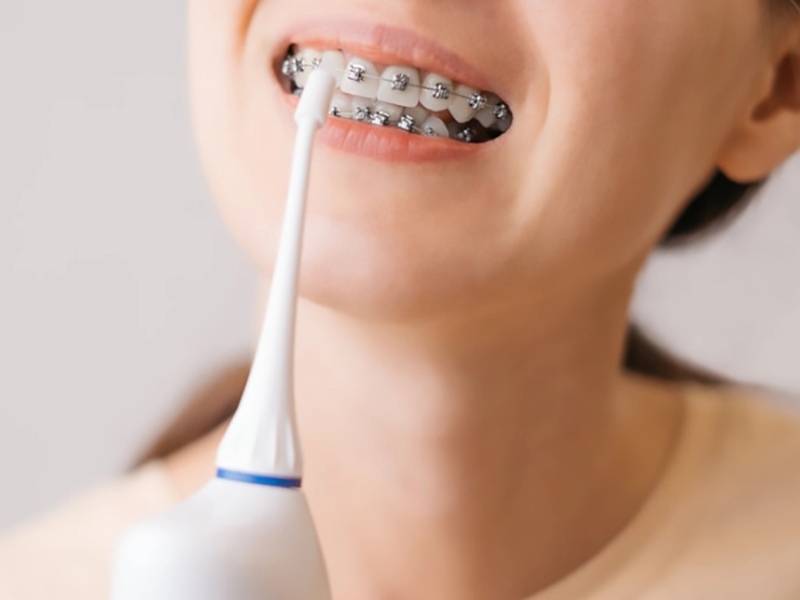 Máy tăm nước giúp người niềng răng ngăn ngừa các bệnh về nướu