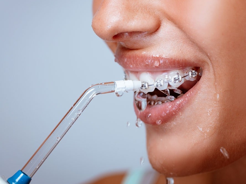 Áp lực nước là yếu tố rất quan trọng khi chọn máy tăm nước cho người niềng răng
