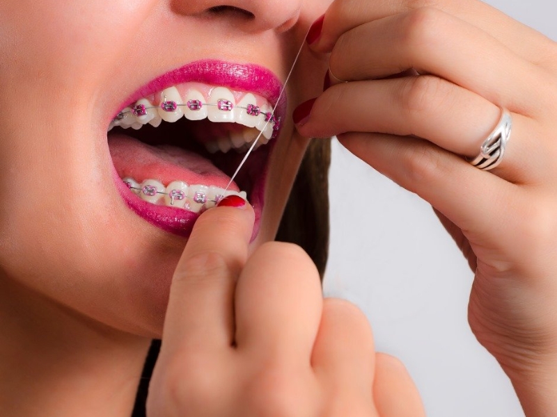 Hướng dẫn sử dụng chỉ nha khoa cho người đang niềng răng