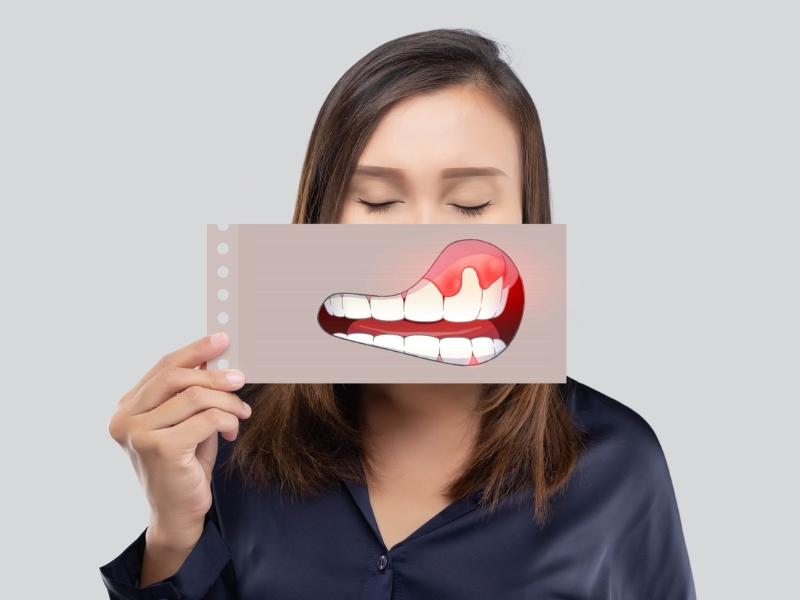 Viêm lợi là nguyên nhân hàng đầu gây chảy máu khi đánh răng