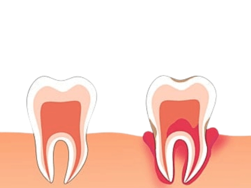 Nếu tình trạng viêm lợi không được điều trị sớm, nó có thể tiến triển thành viêm nha chu