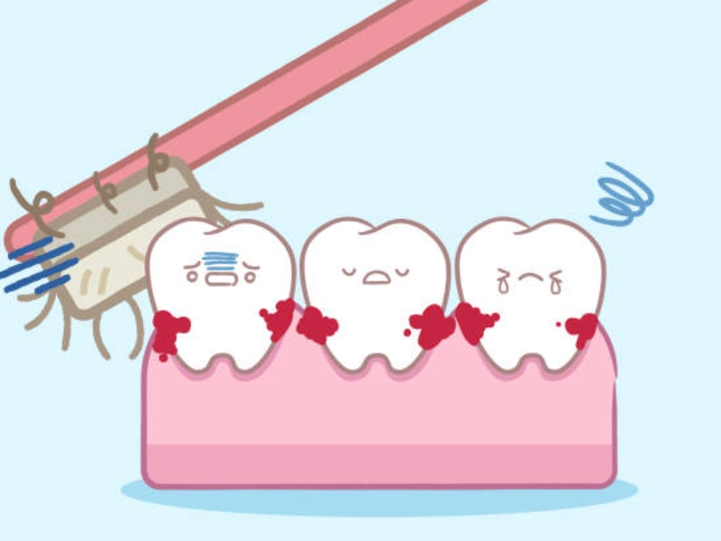 Sử dụng bàn chải đánh răng có đầu lông quá cứng hoặc chải răng với lực quá mạnh đều có thể dẫn đến chảy máu khi đánh răng