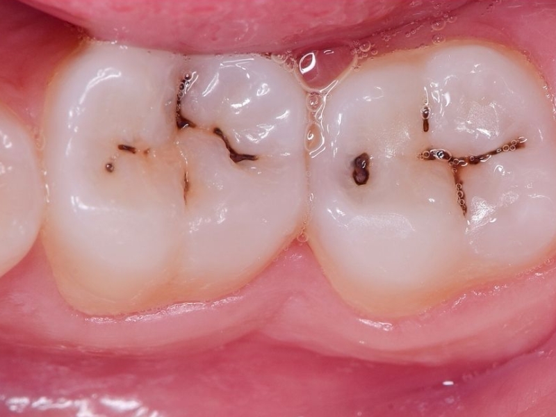 Sâu răng dẫn đến ê buốt răng kéo dài, thậm chí là đau dữ dội