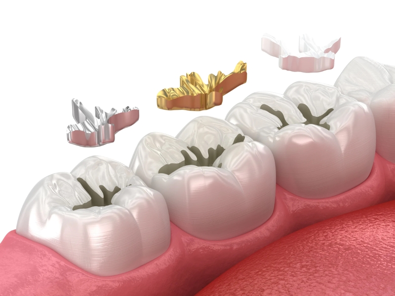 Nha sĩ có thể trám răng để xử lý tình trạng răng ê buốt