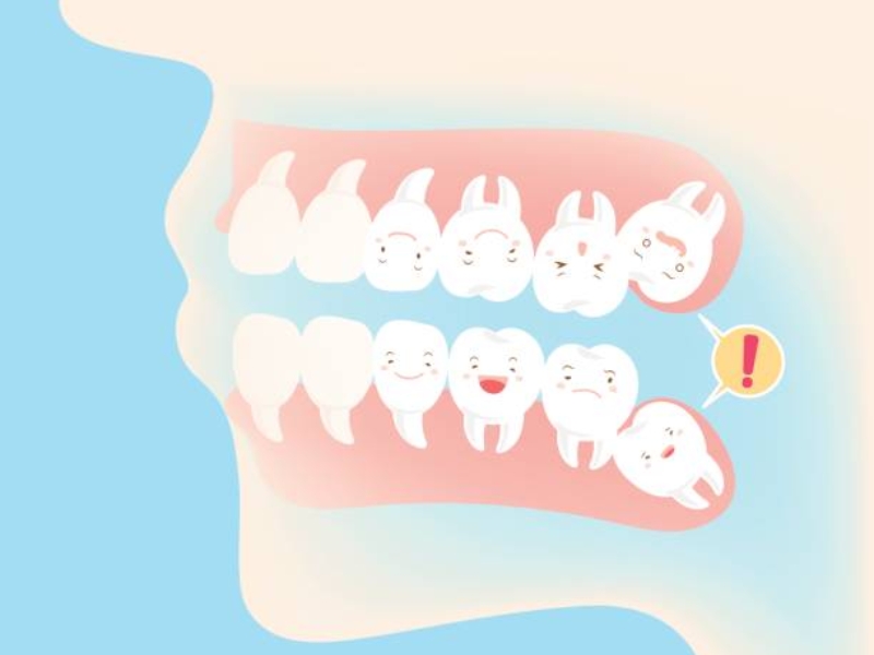 Mọc răng khôn gây sưng nướu hàm