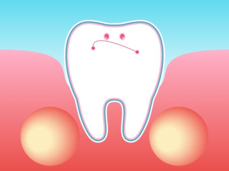 Áp xe răng gây sưng lợi răng hàm